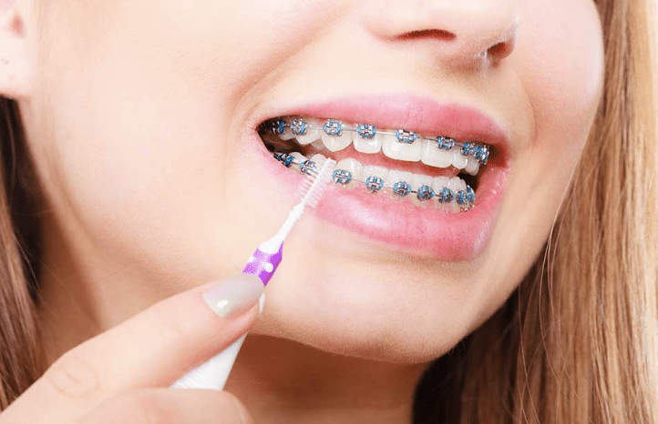 Top tips for taking care of braces